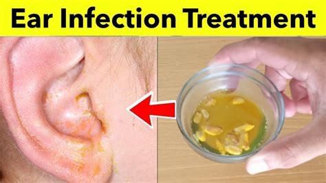 brilliant tips    cure  baby ear infection blockbath