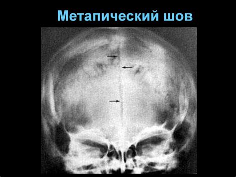 Рентгеноанатомия черепа - презентация онлайн