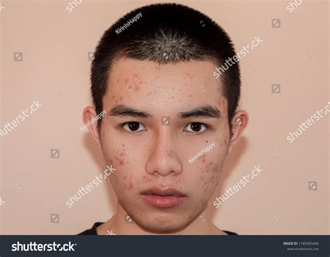 young man acne pimple  skin stock photo  shutterstock
