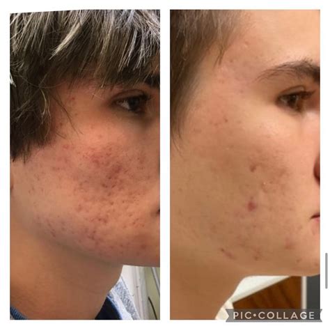 Procell Micro Channeling - Flatirons Dermatology