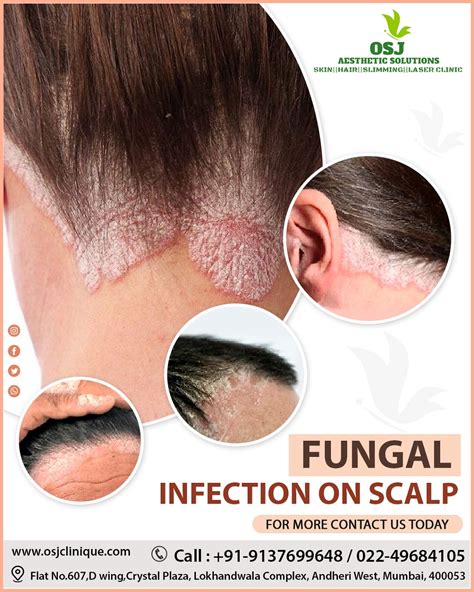 Hair Fungus Treatment, Scalp Odor Fungus, Causes Of Fungal, 54% OFF