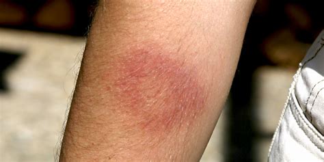 Lyme-Borreliose: Welche Symptome kommen vor? | Apotheken Umschau