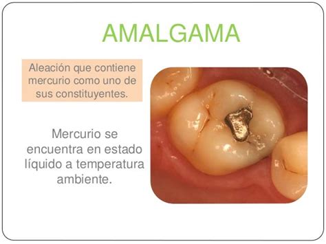 O Que Significa Amalgama - Qu Es Una Amalgama Dental Odontotecks AUXILIAR DE FARMACIA