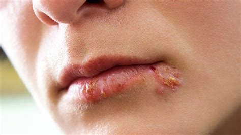 10 Frequently Asked Questions About Cold Sores