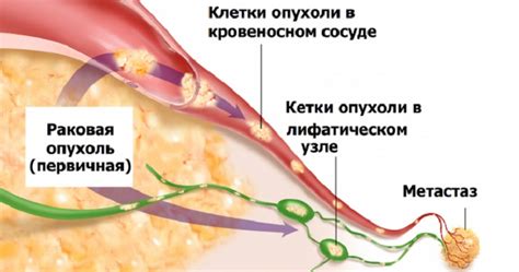 Остеофиты позвоночника: лечение, симптомы, формы
