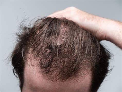 Do Ozempic, Wegovy, Mounjaro & Zepbound cause hair loss?