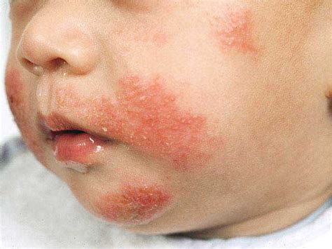 Pediatric Health: Atopic Dermatitis (Eczema) in Children