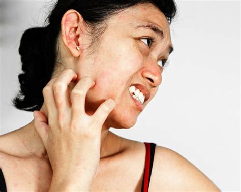How to Heal—and Conceal—a Massive, Itchy Bug Bite Quickly | Skin ...