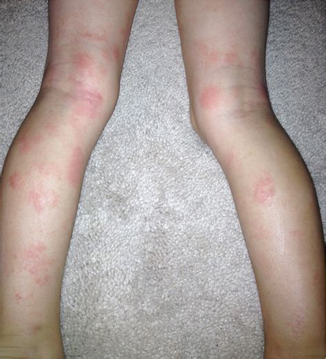 common skin rashes  children aafp