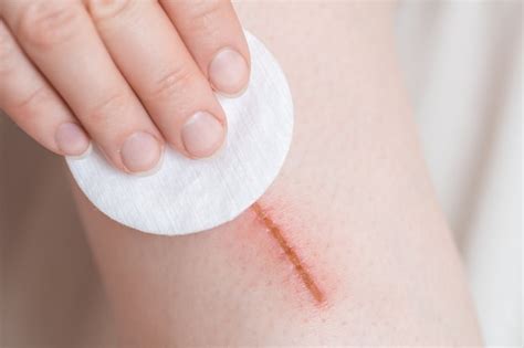 premium photo scratch fresh wounds