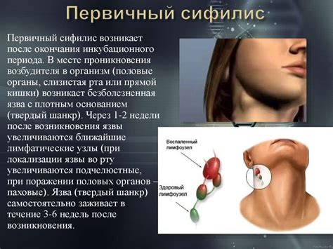 Сифилис. Симптомы сифилиса. Лечение сифилиса - презентация онлайн