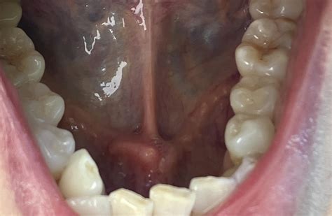 Any ideas what this lump under my tongue is? : r/DiagnoseMe