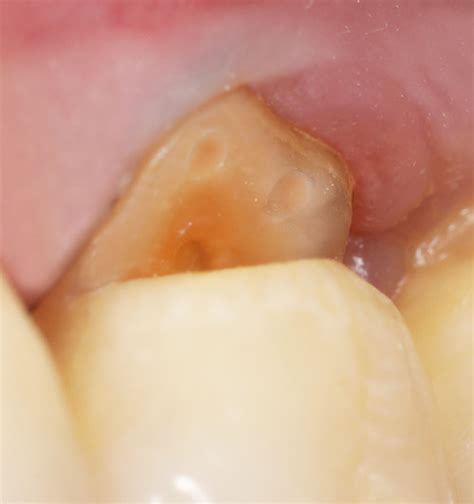 noncarious cervical lesions morphology  progression prevalence