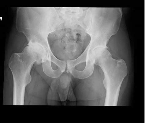 Hip Arthritis – Prof. Ibrahim Malek