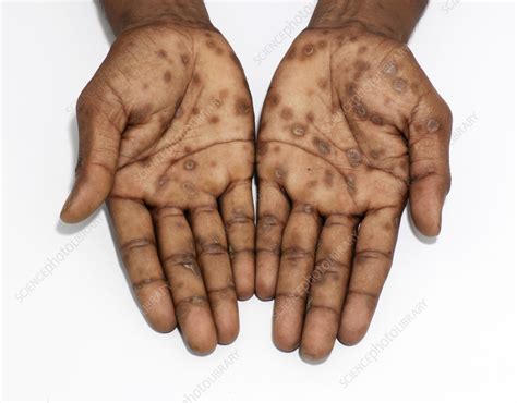 Secondary syphilis lesions on a man's palms - Stock Image - C060/3148 ...