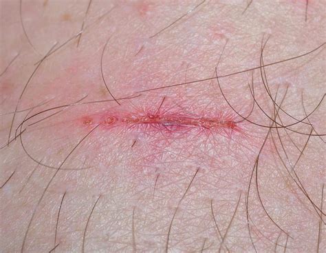 How to Tell if a Wound is Healing or Infected? Amazing Facts!