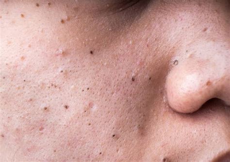 Forget Everything You Know: This is Unbelievable Blackhead Removal 2024 - 3kdwmrp