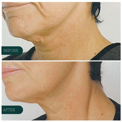 MEDI-LIFT — Meraki Beauty and Wellness