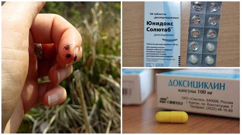 Как принимать Доксициклин при укусе клеща