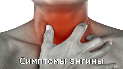 Симптомы ангины - YouTube
