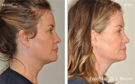 FaceTite Before and After - Joseph Eye and Laser