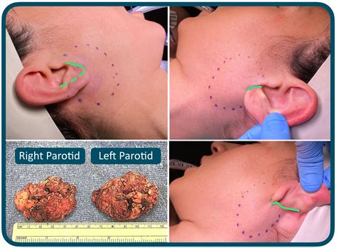 Carcinoma Ex Pleo Left Tail Of Parotid 8