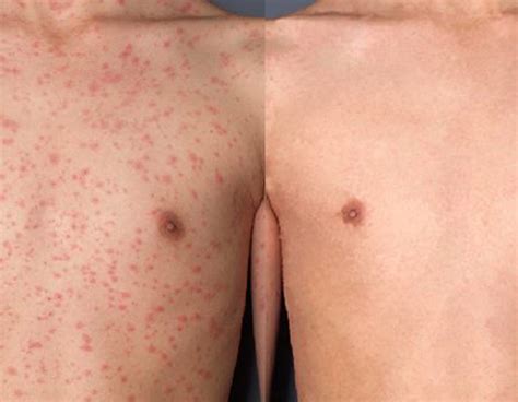 pityriasis rosea treatment brisbane pityriasis rosea specialists