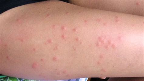 sand flea bites  children