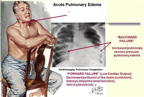 Medicina y Melodía: Cuando nos falta el aire: Disnea