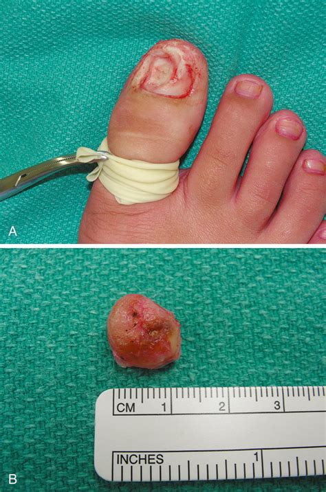 Disorders of Nails - Clinical Tree
