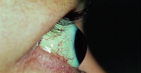 ophthalmology: EKZOFTALMI