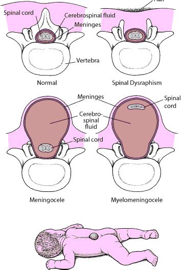 Quick Facts: Spina Bifida - MSD Manual Consumer Version