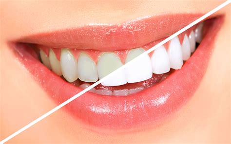 Teeth bleaching – Palermo Dental Care