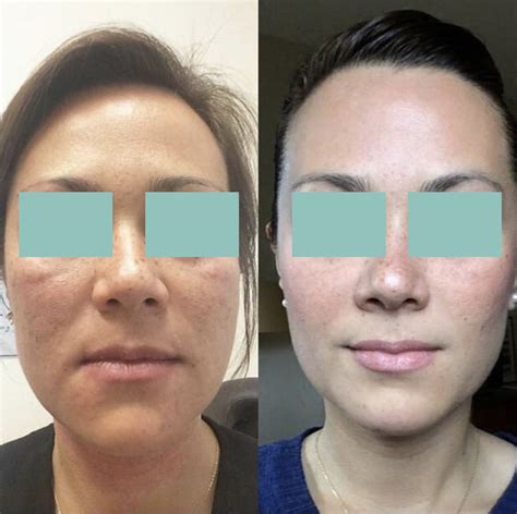 Platelet Rich Plasma Therapy PRP — The Dermal Health Alliance