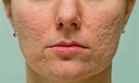 What is acne? - Dr Justine Kluk