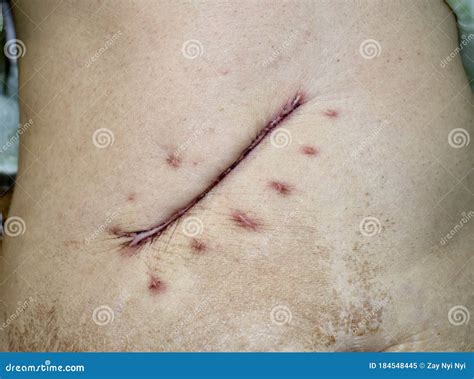 kochers incision  subcostal  oblique incision  open