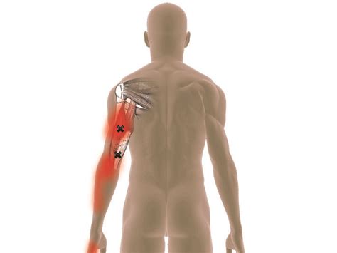 arm trigger points