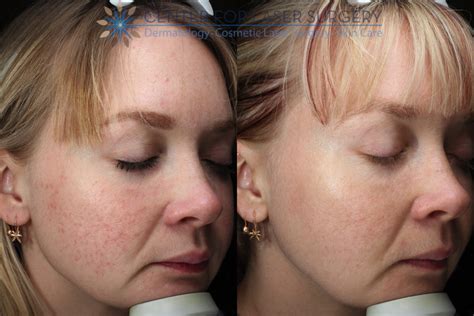 Rosacea Specialist | Washington, DC | Center for Laser Surgery