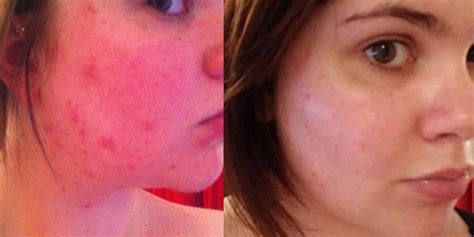 La Roche-Posay Effaclar Duo+ :: before and after pictures