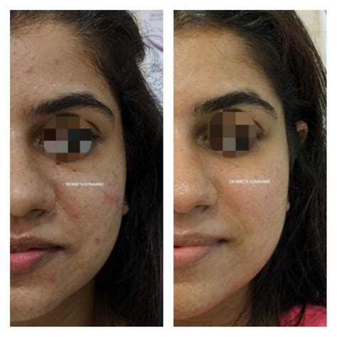 dermatologist  mumbai skin treatment