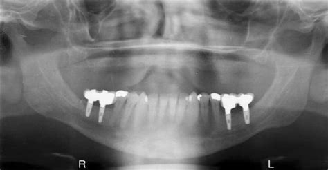 Onlay Ramus Block Bone Grafting | Prosthodontist Overland Park, KS