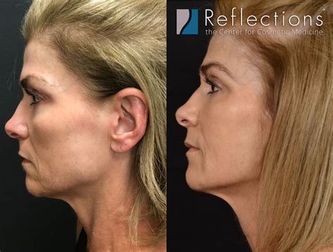 MINT Thread Lift Instant Non Surgical Facelift With Threads, 53% OFF