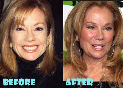 Kathie Lee Gifford Plastic Surgery Facelift, Facial Filler - Lovely Surgery | Celebrity Before ...