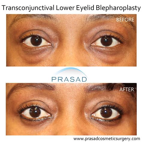 Lower Blepharoplasty Before and After Photos