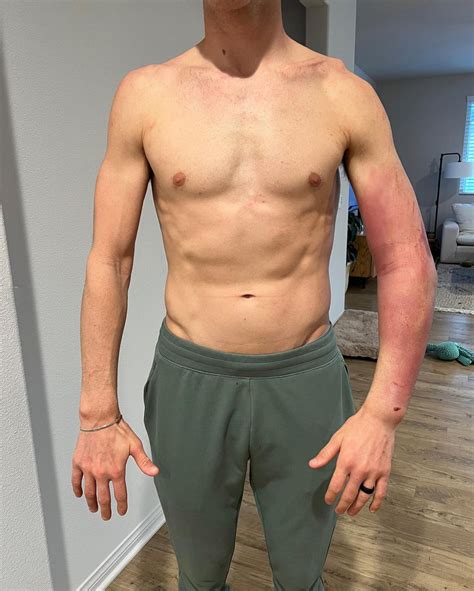 Cameron McAdoo's Update on His Arm and Anaheim 2 - Motocross News Story