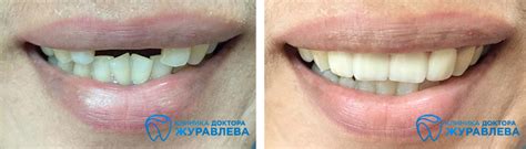 Мосты На Зубы Фото Цены — Photoby.Ru