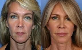 Recessed Maxilla: How to Fix, Before & After