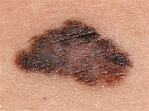 Melanoma - Pictures