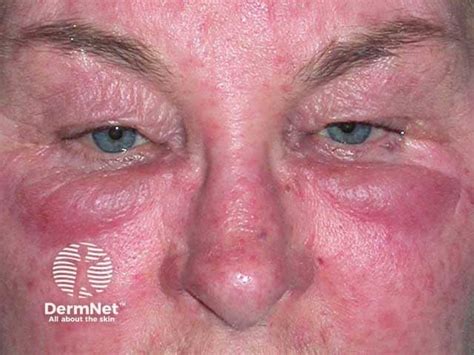 morbihan disease