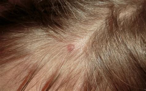 Scalp Pimples: Causes, Treatment, and Prevention